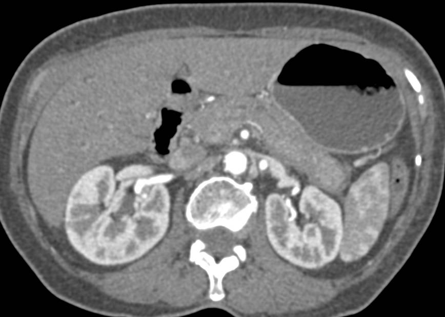 Autoimmune Pancreatitis - CTisus CT Scan