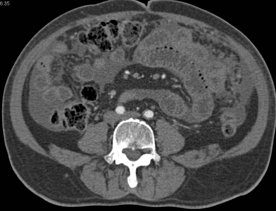 Carcinomatosis due to Carcinoma of the Tail of the Pancreas - CTisus CT Scan