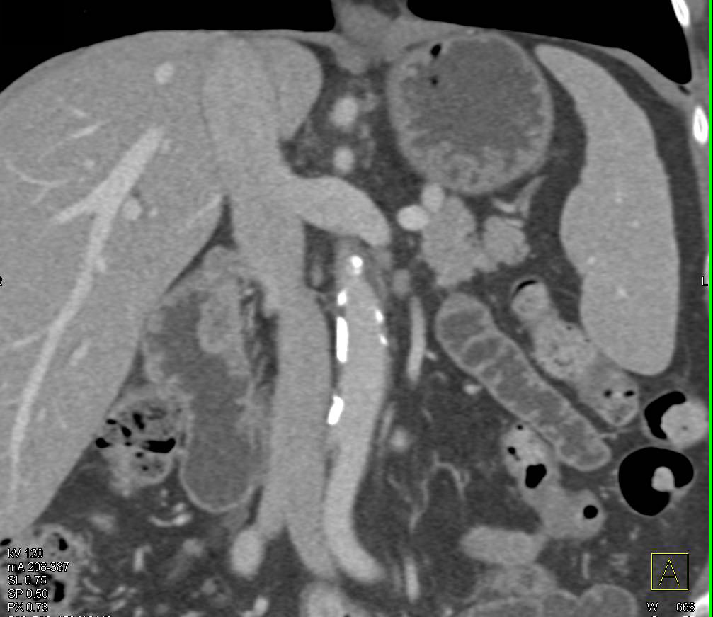 Ampullary Carcinoma - Pancreas Case Studies - CTisus CT Scanning