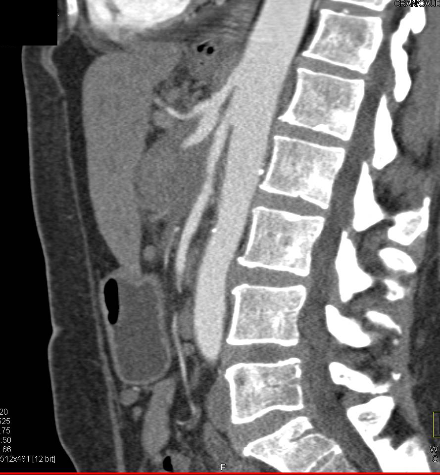 Pancreatic Cancer with Arterial and Venous Encasement with Superior Mesenteric Artery (SMA) and Celiac Encased on Arterial Phase - CTisus CT Scan