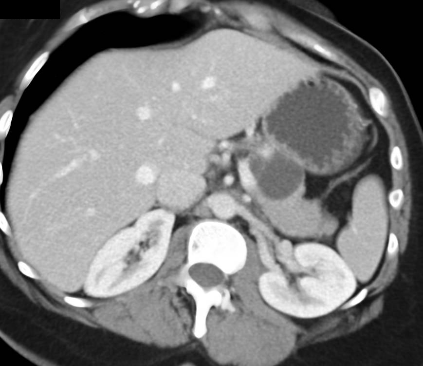 Mucinous Cystic Neoplasm (MCN) of the Pancreas - CTisus CT Scan