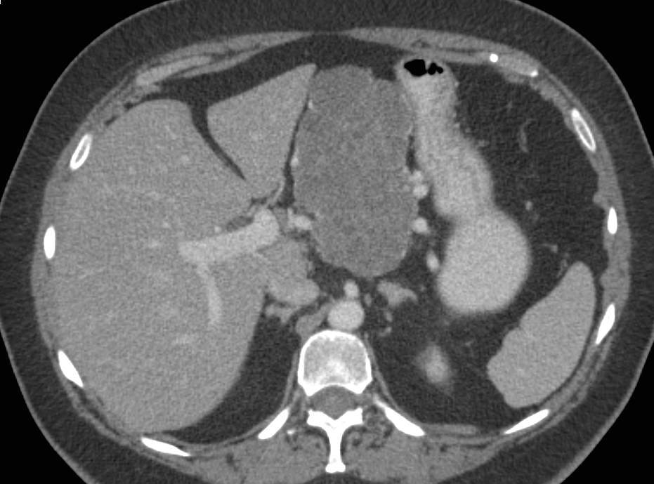 Serous Cystadenoma of the Pancreas - CTisus CT Scan