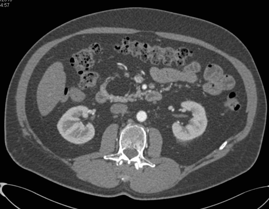 Lipoma of the Head of the Pancreas in Multiple Perspectives - CTisus CT Scan