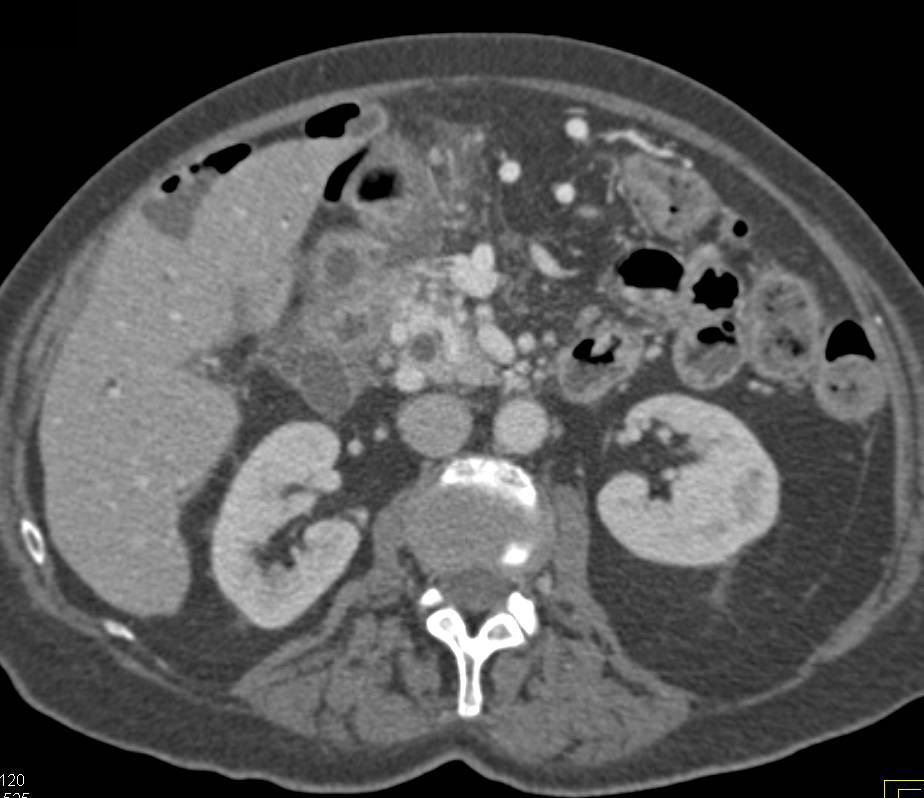 Pancreatic Cancer Encases and Occludes the Portal Vein/SMV Confluence with Extensive Collaterals - CTisus CT Scan