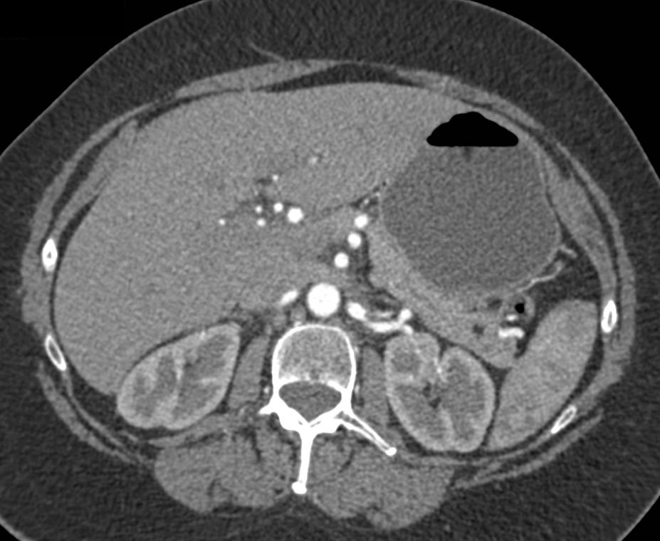 Lipoma in the Pancreas - Pancreas Case Studies - CTisus CT Scanning