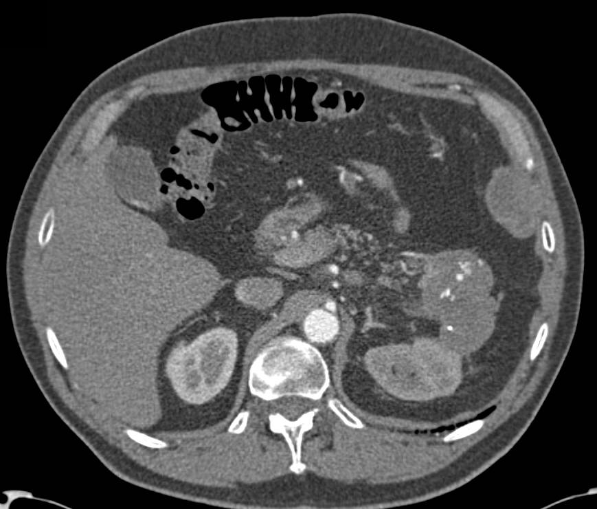 Neuroendocrine Tumor in the Tail of the Pancreas - CTisus CT Scan