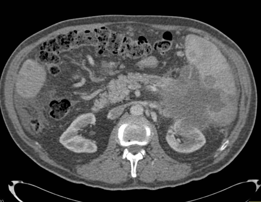 Pancreatic Cancer Invading the Spleen with Liver Metastases also seen. Patient presented with Gastric Outlet Obstruction Symptoms - CTisus CT Scan