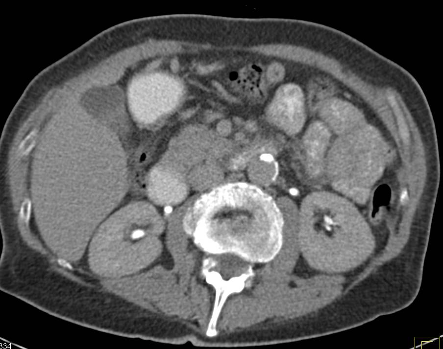 Pancreatic Cancer with Arterial and Venous Encasement - CTisus CT Scan