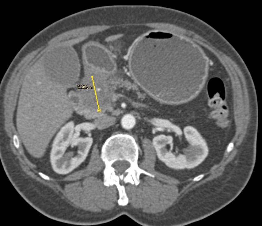 Pancreatic Cancer Encases the PV/SMV and also Invades the Duodenum - CTisus CT Scan