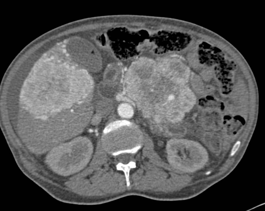 Neuroendocrine Tumor of the Pancreas with Liver Metastases and Vascular Invasion - CTisus CT Scan