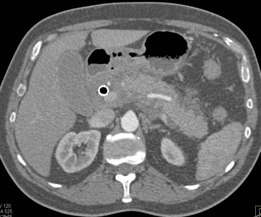 Pancreatic Cancer with Secondary Pancreatitis - CTisus CT Scan