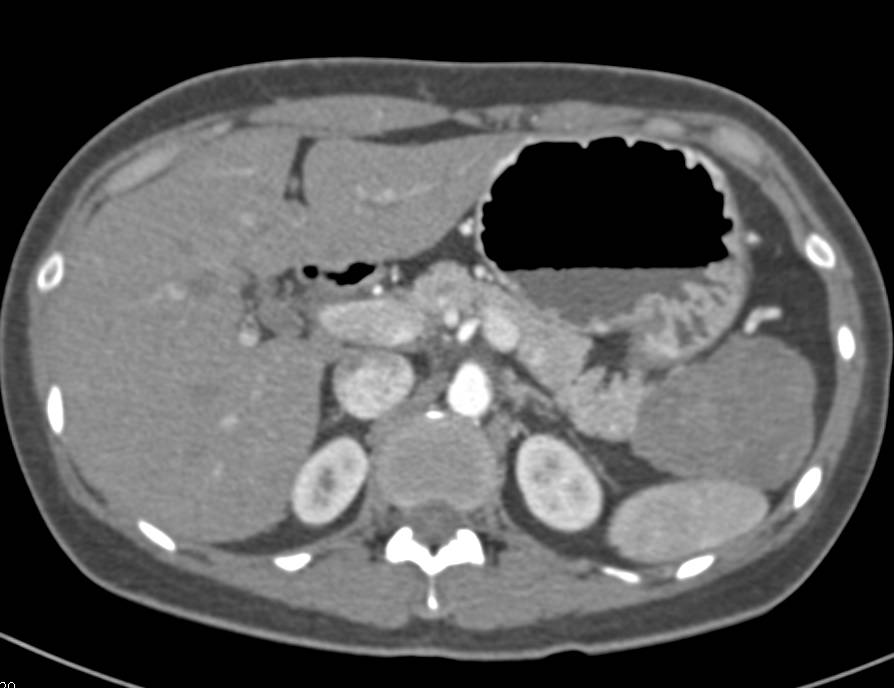SPEN or Hamoudi Tumor of the Tail of the Pancreas - CTisus CT Scan