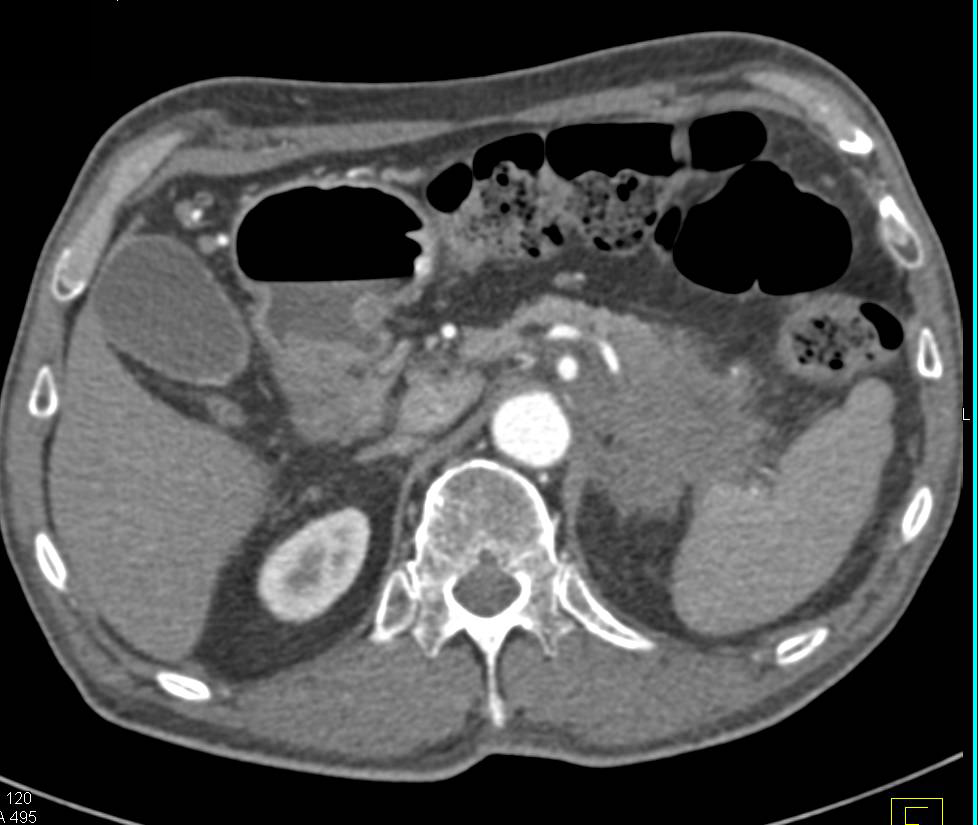Infiltrating Adenocarcinoma of the Tail of the Pancreas - CTisus CT Scan