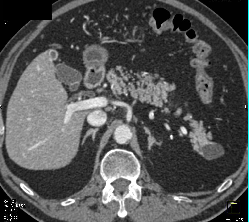 Intraductal Papillary Mucinous Neoplasm (IPMN) Tail of Pancreas with 3D Perspectives - CTisus CT Scan