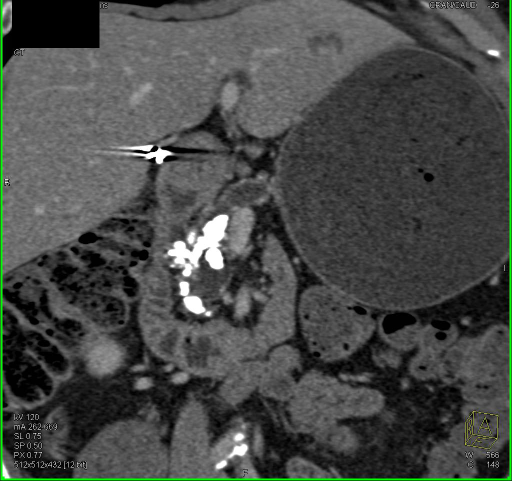 Chronic Pancreatitis with a Dilated Pancreatic Duct - CTisus CT Scan