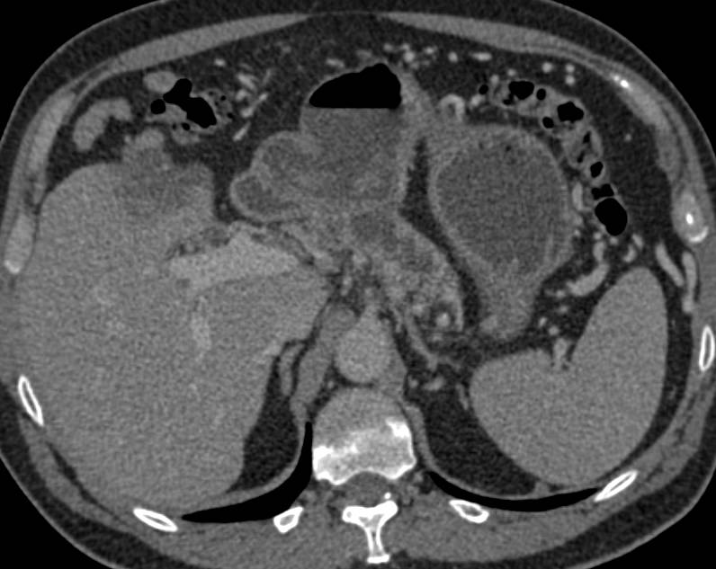 Pancreatic Cancer Obstructs the Pancreatic Duct - CTisus CT Scan