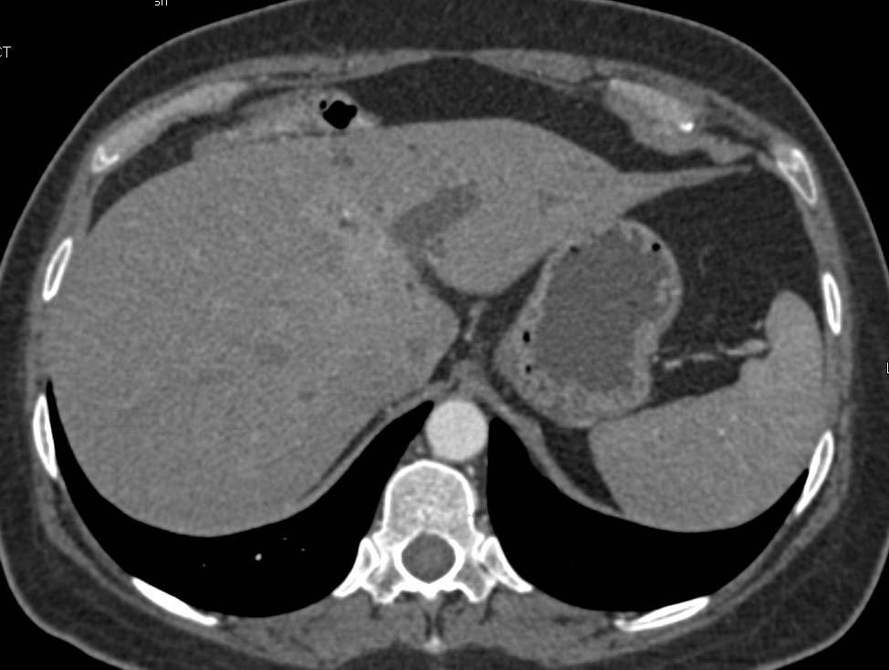 Dilated Common Bile Duct (CBD) with No Obvious Mass - CTisus CT Scan