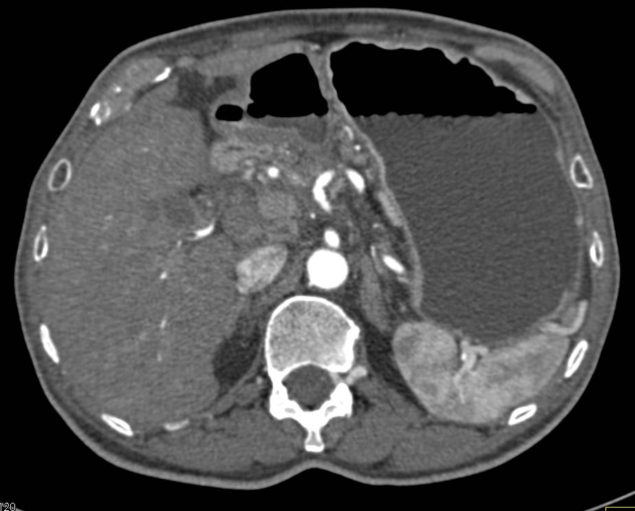 Pancreatic Cancer with Encasement and Occlusion of PV/SMV/SV Complex - CTisus CT Scan