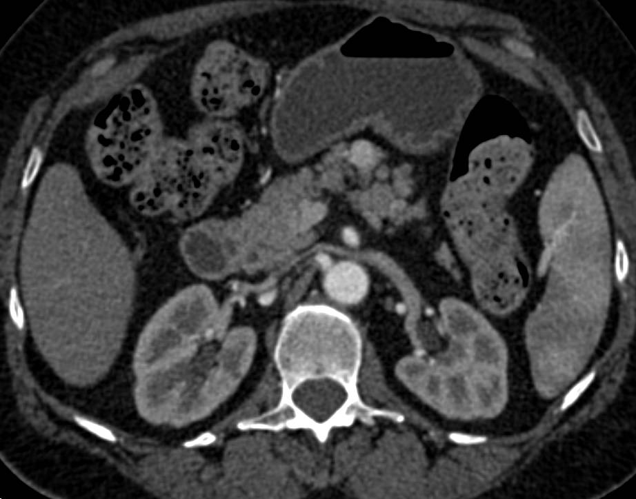 1 Cm Neuroendocrine Tumor in the Body of the Pancreas - CTisus CT Scan