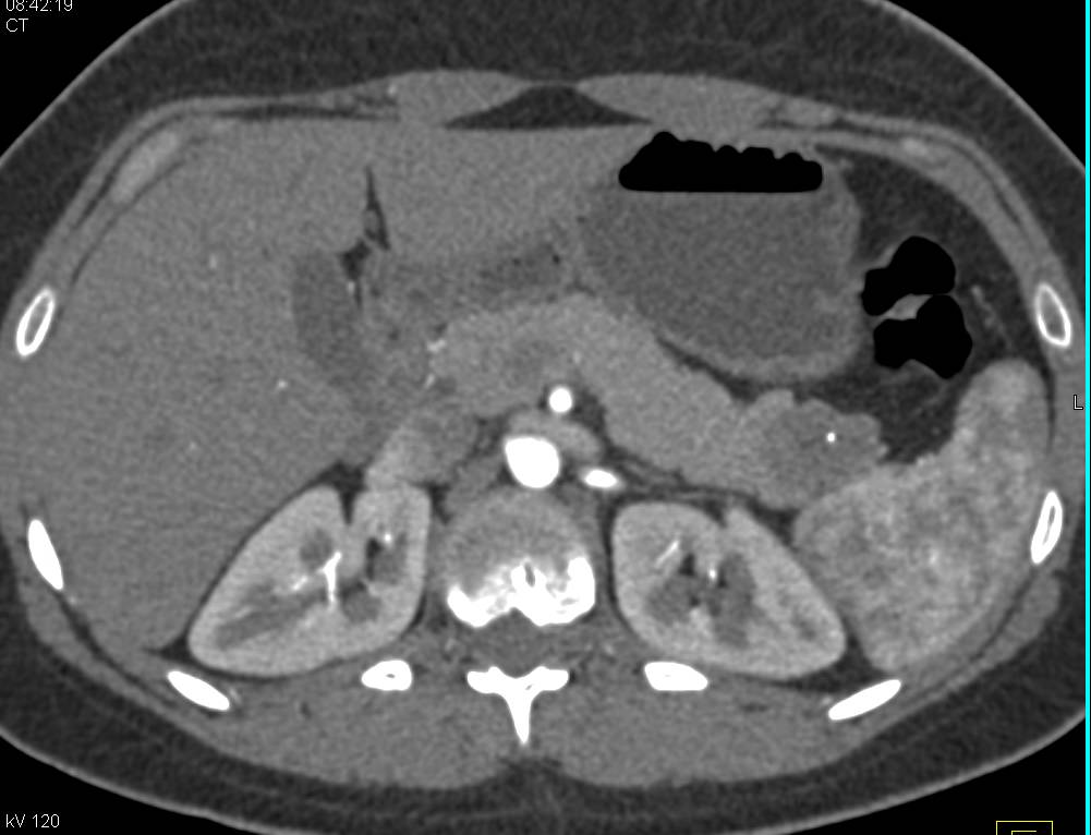 Serous Cystadenoma in the Tail of the Pancreas - CTisus CT Scan