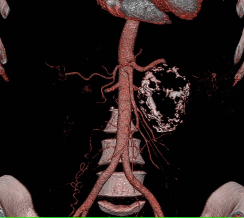 Neuroendocrine Tumor in the Tail of the Pancreas - CTisus CT Scan