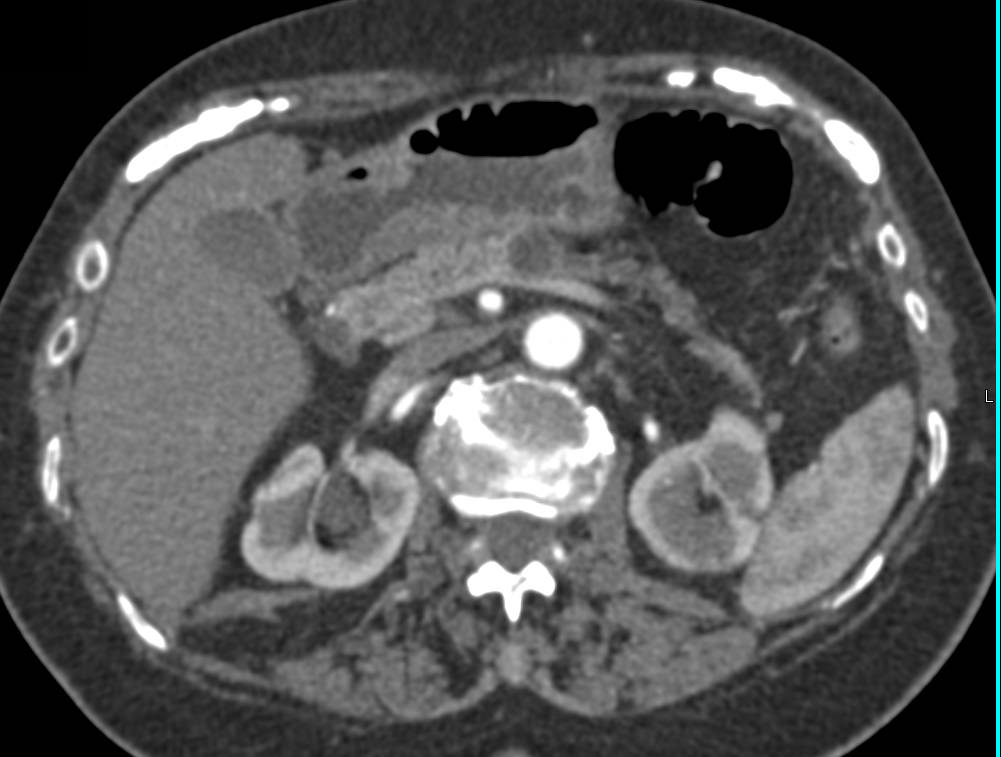 Mucinous Cystadenocarcinoma Obstructs the Pancreatic Duct - CTisus CT Scan