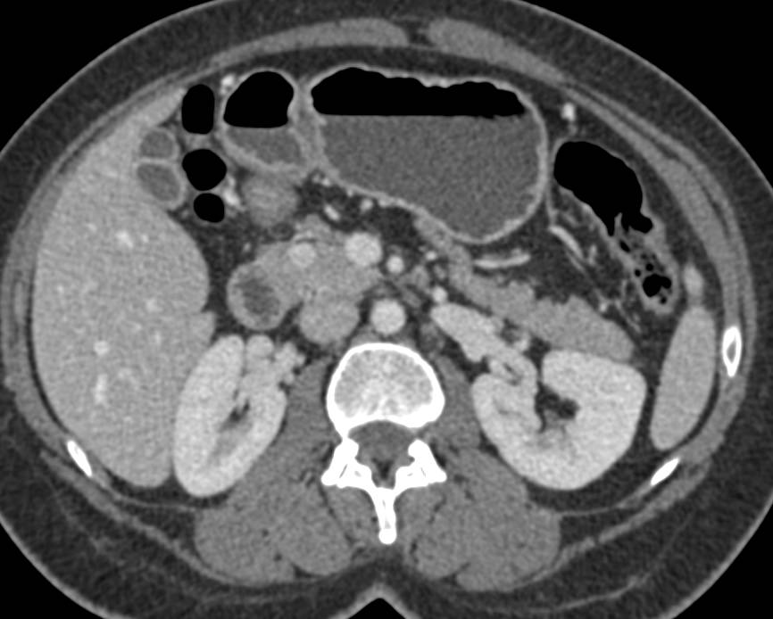 1 cm Neuroendocrine Tumor in the Head of the Pancreas - CTisus CT Scan