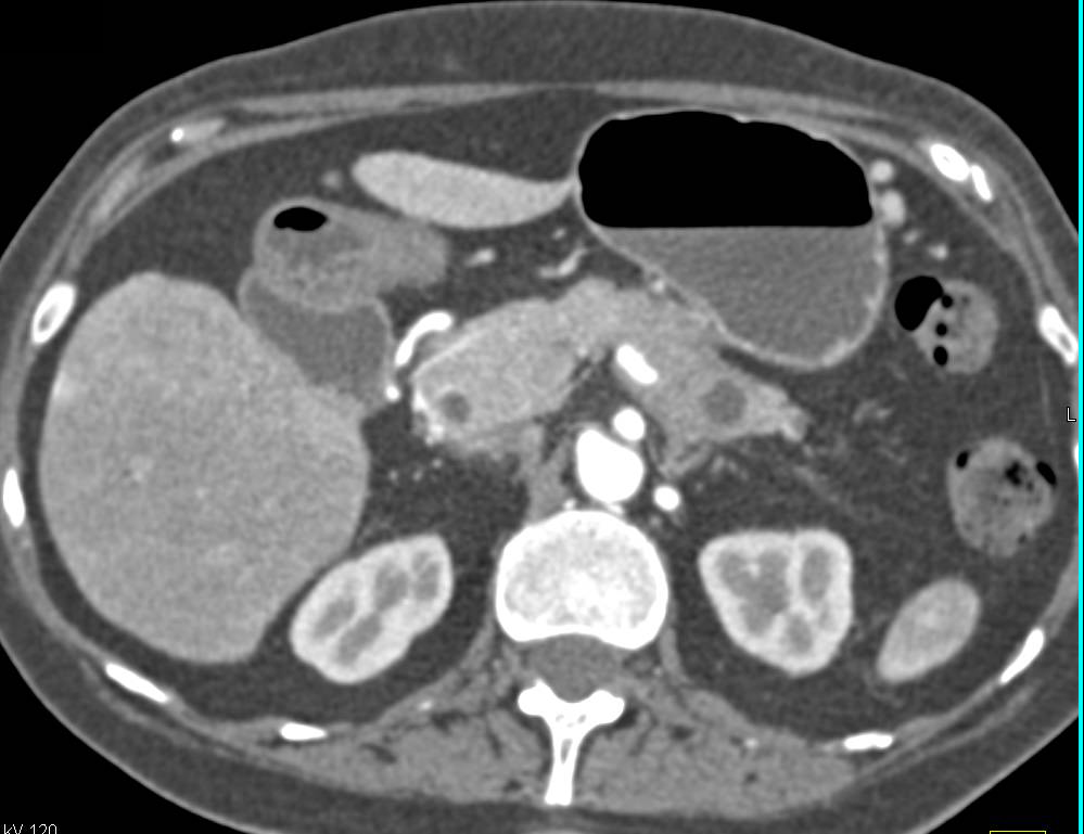 Intraductal Papillary Mucinous Neoplasm (IPMN) of the Pancreas - CTisus CT Scan