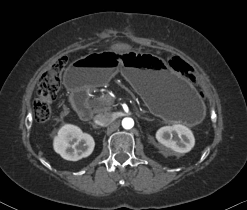 Pancreatic Cancer Presents with Gastric Outlet Obstruction Symptoms due to Invasion of Duodenum - CTisus CT Scan