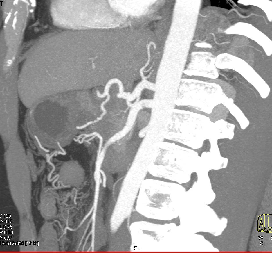 Carcinoma of the Head of the Pancreas Encases the Gastroduodenal Artery (GDA) and Occludes PV/SMV Confluence with Collaterals. Liver Metastases Also Seen. - CTisus CT Scan