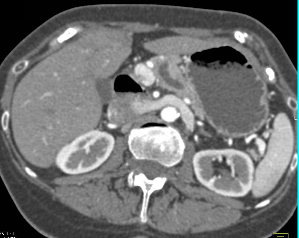 Serous Cystadenoma of the Pancreas - CTisus CT Scan