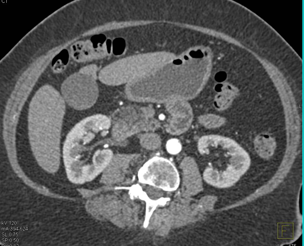 Focal Fatty Infiltration Head of Pancreas - CTisus CT Scan