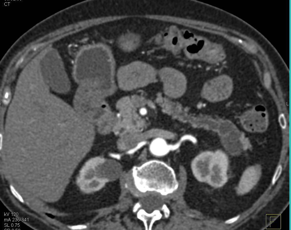 Intraductal Papillary Mucinous Neoplasm (IPMN) Tail of Pancreas with Dysplasia - CTisus CT Scan