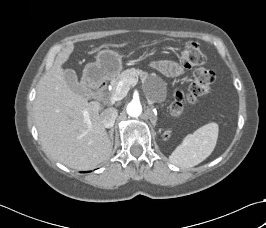 Serous Cystadenoma - CTisus CT Scan