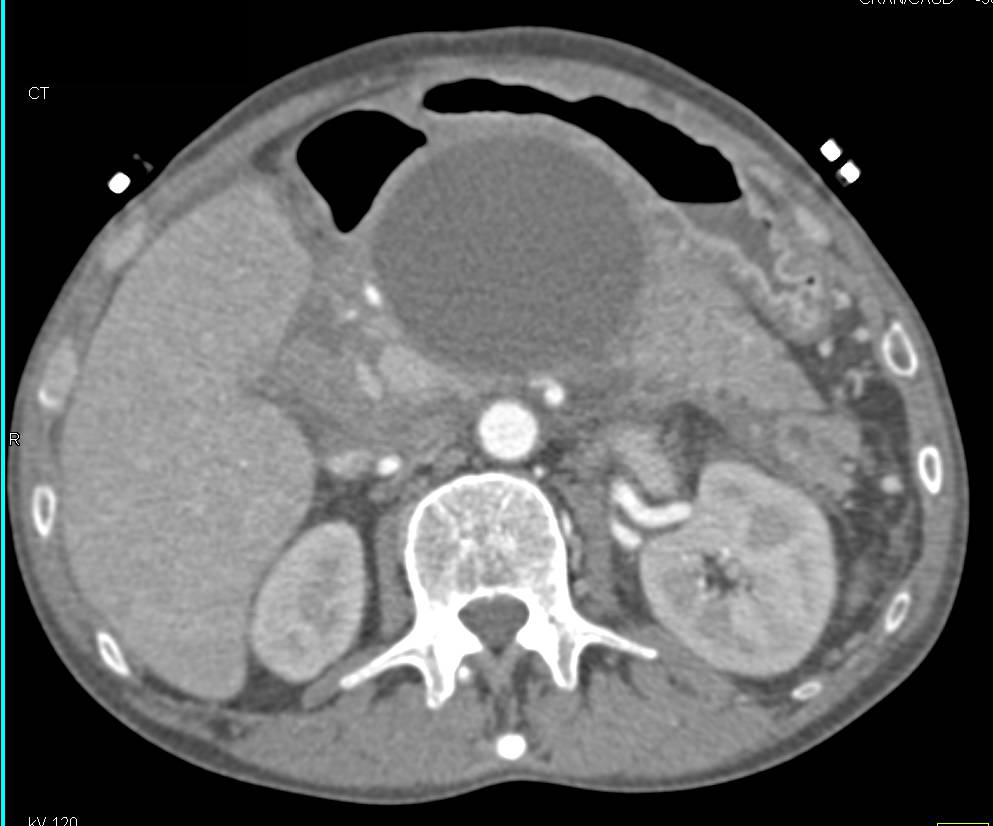 Sequential Scans of an Enlarging Pancreatic Pseudocyst - CTisus CT Scan