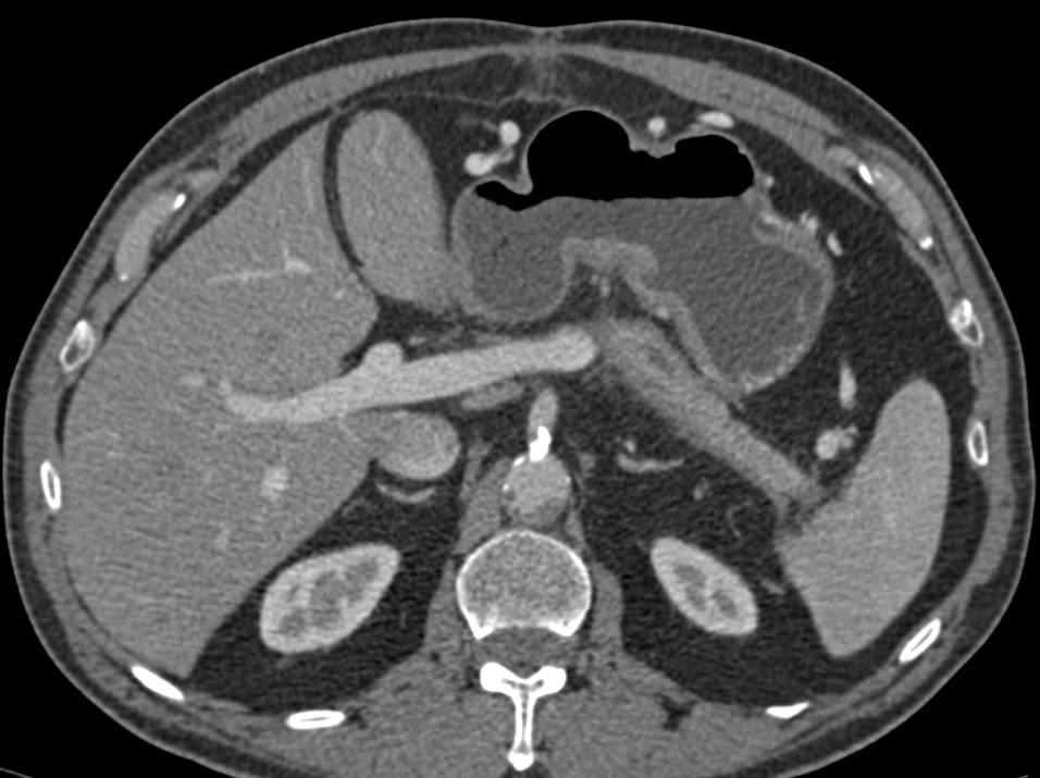 Pancreatic Cancer Occludes the Splenic Vein with Collaterals - CTisus CT Scan