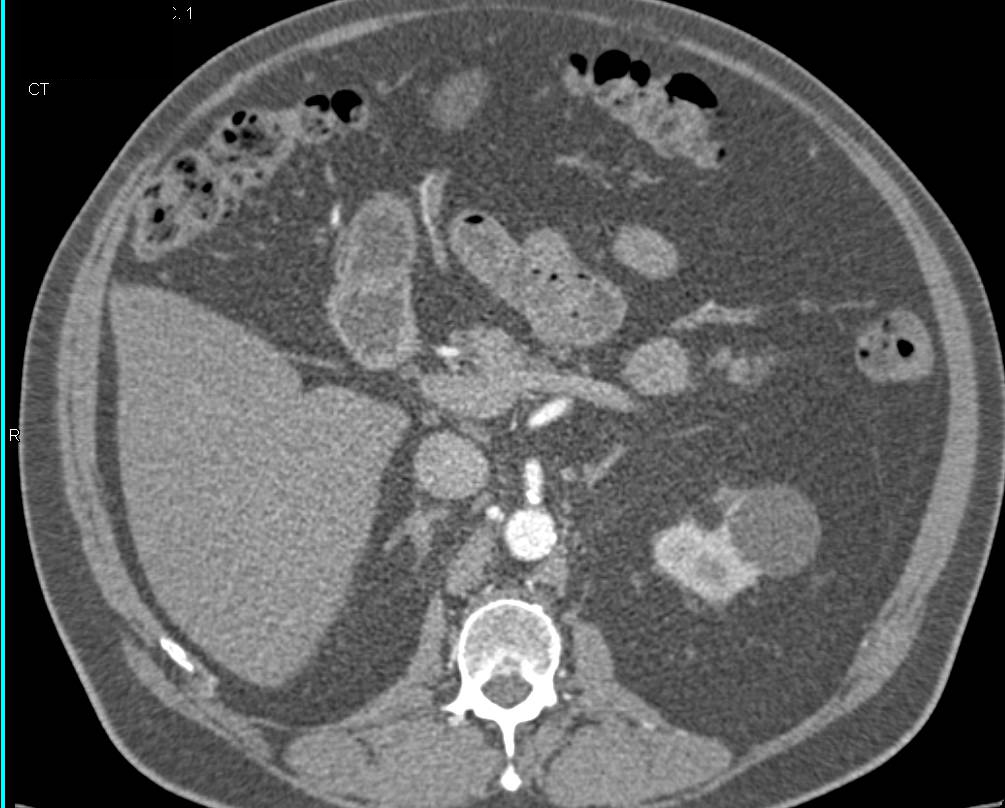 Subtle 2cm Neuroendocrine Tumor Arises off the Pancreatic Tail - CTisus CT Scan