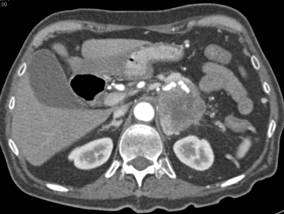 Carcinoma of the Tail of the Pancreas - CTisus CT Scan