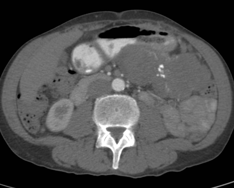 Hamoudi Tumor (SPEN) - CTisus CT Scan