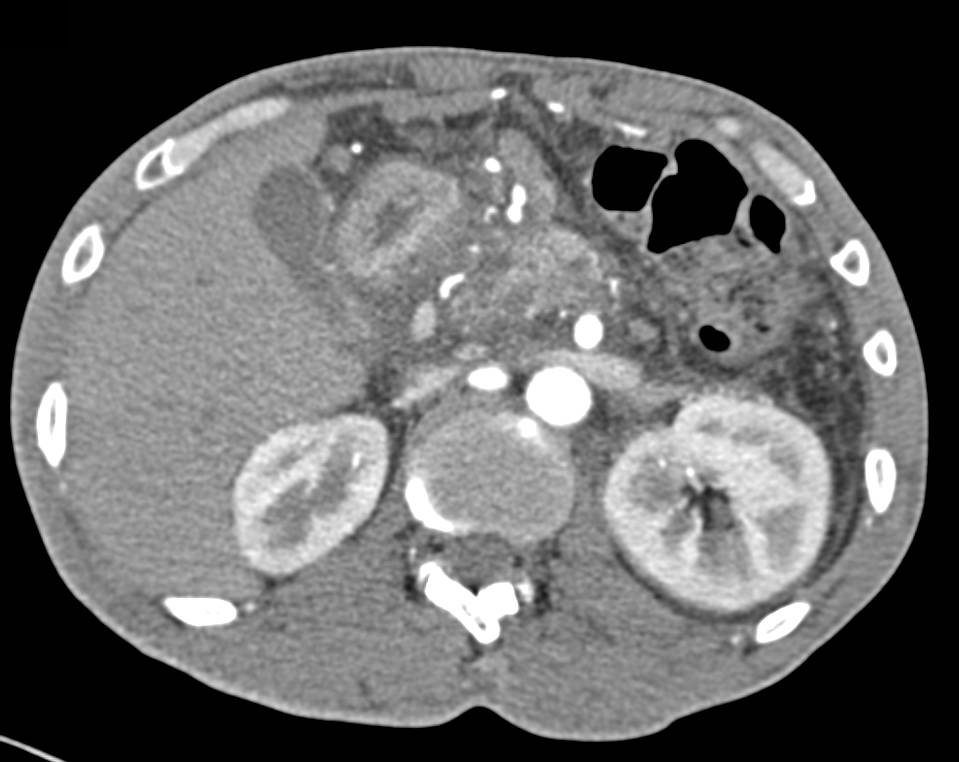 Pancreatic Cancer with Portal Vein Encasement and Splenic Vein Occlusion - CTisus CT Scan