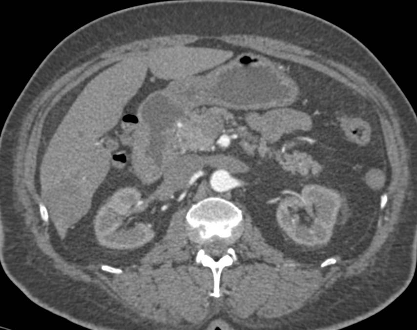 Cystic Lesion in Head of Pancreas - CTisus CT Scan