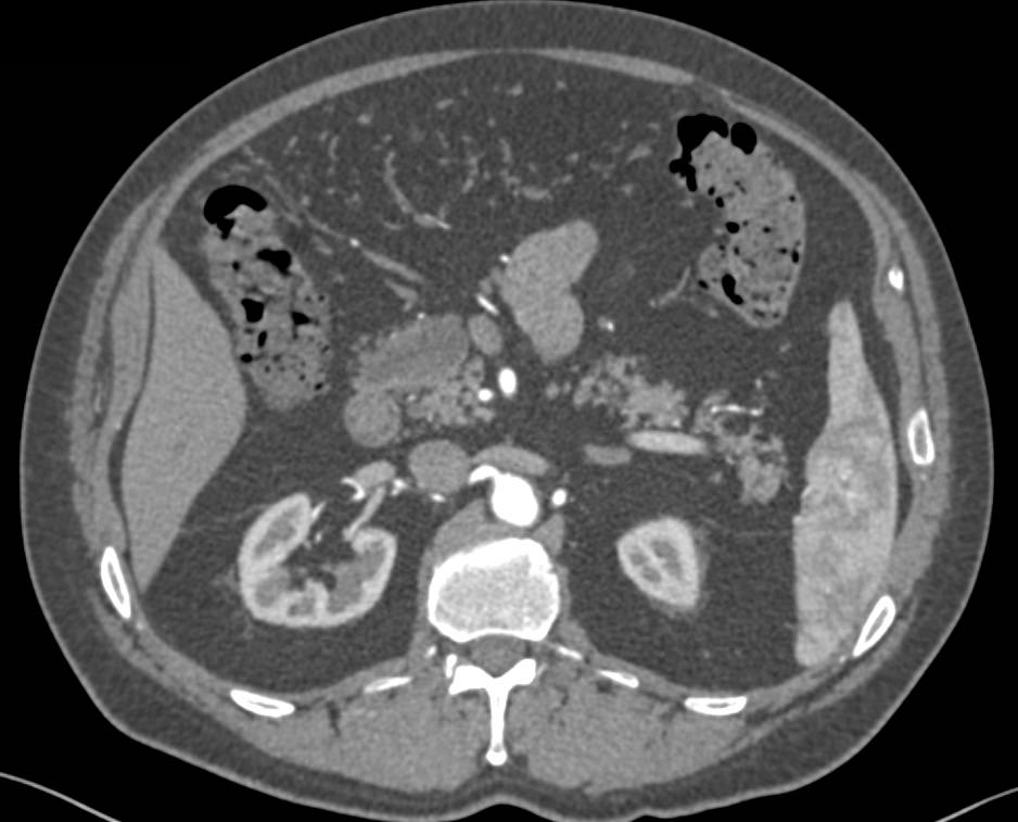 Intraductal Papillary Mucinous Neoplasm (IPMN) of the Pancreatic Head - CTisus CT Scan