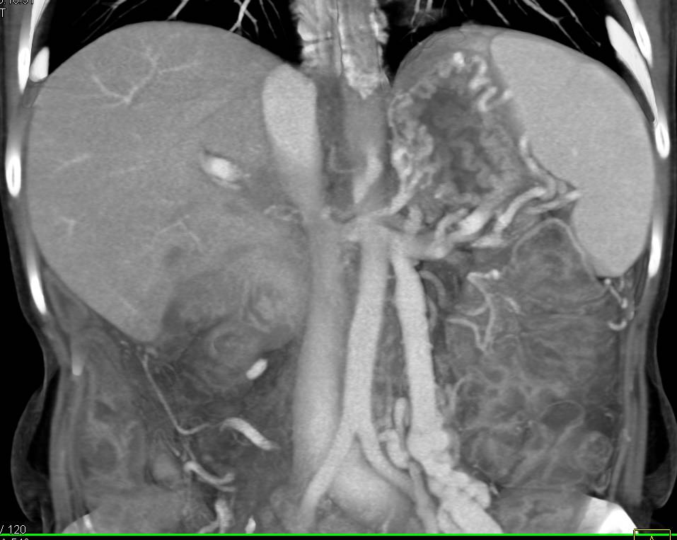 Pancreatic Cancer Encases the Portal Vein/SMV/Splenic Vein Junction with marked Narrowing of the SMV , Occlusion of the Splenic Vein and Huge Collaterals - CTisus CT Scan