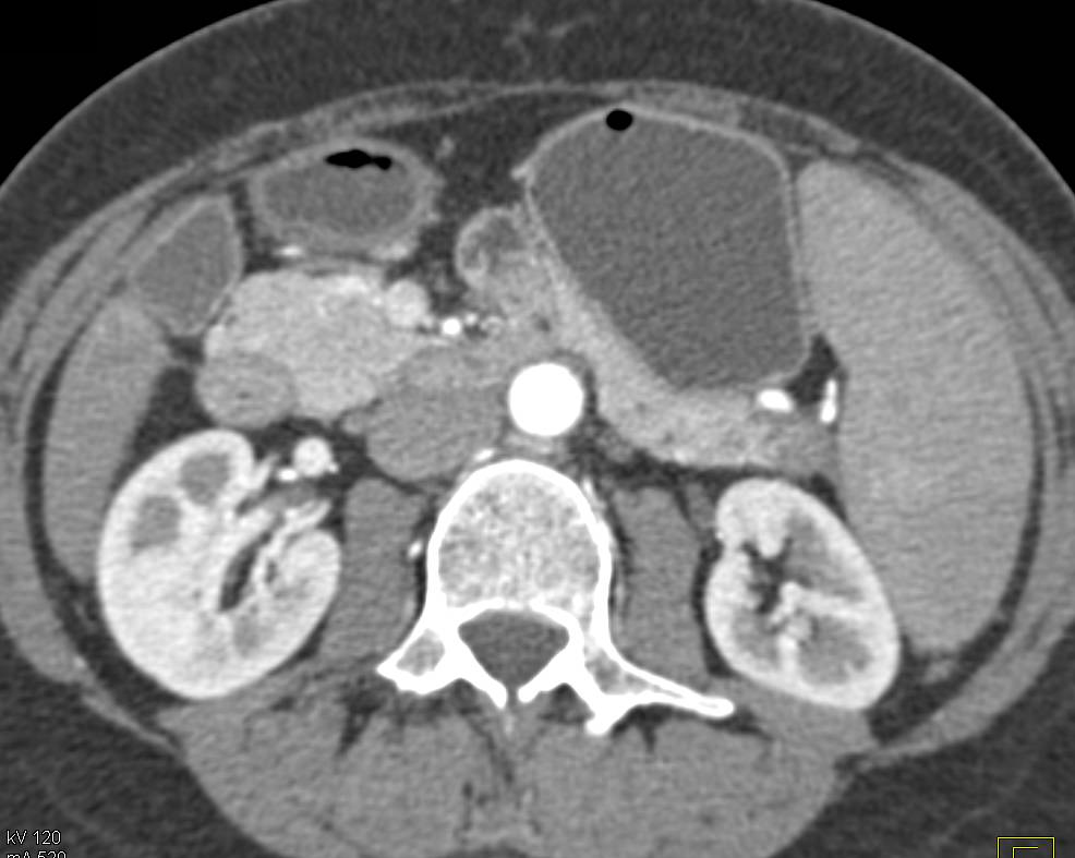 Focal Mass in tail of the Pancreas - CTisus CT Scan