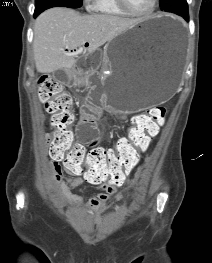 Whipple with Patent Anastomosis (gastrojejunostomy) - CTisus CT Scan