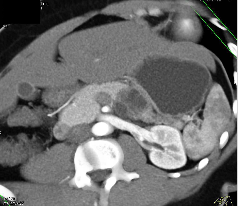 Hamoudi or SPEN Tumor of the Pancreas - CTisus CT Scan