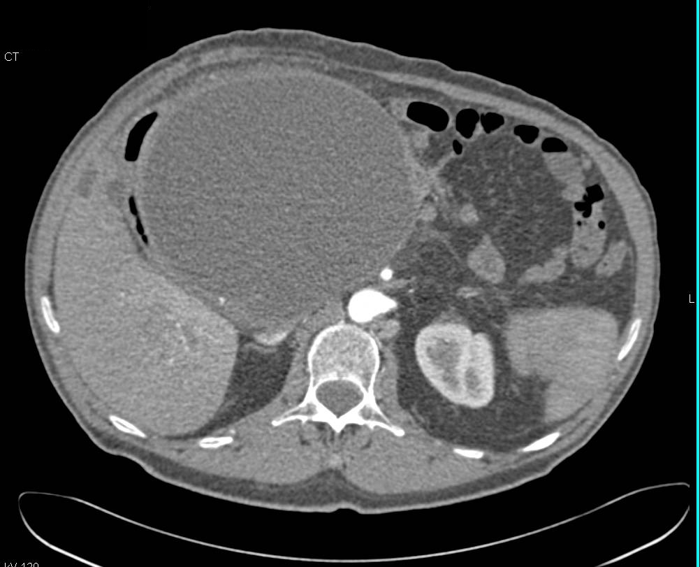 Pseudocyst Near Head of the Pancreas - CTisus CT Scan