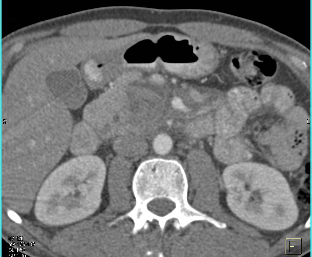 Pancreatic Cancer with Tumor Abutting Vessels - CTisus CT Scan