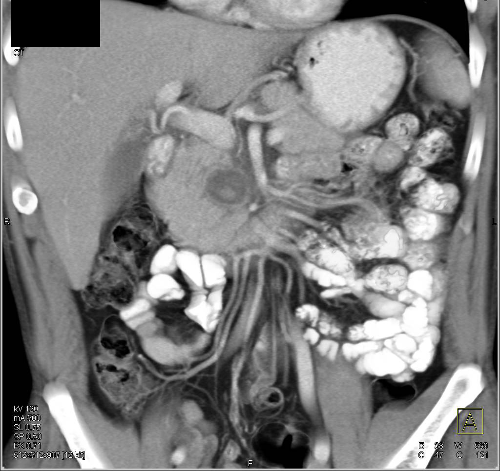 Cystic Neuroendocrine Tumor - CTisus CT Scan