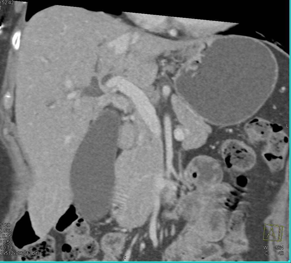 Marked Vascular Enhancement of the Pancreas - CTisus CT Scan